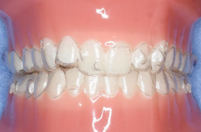 マウスピース矯正