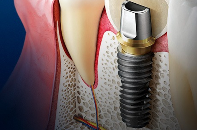 インプラントについて
