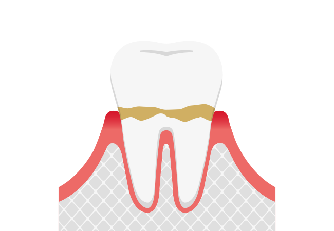 軽度歯周病