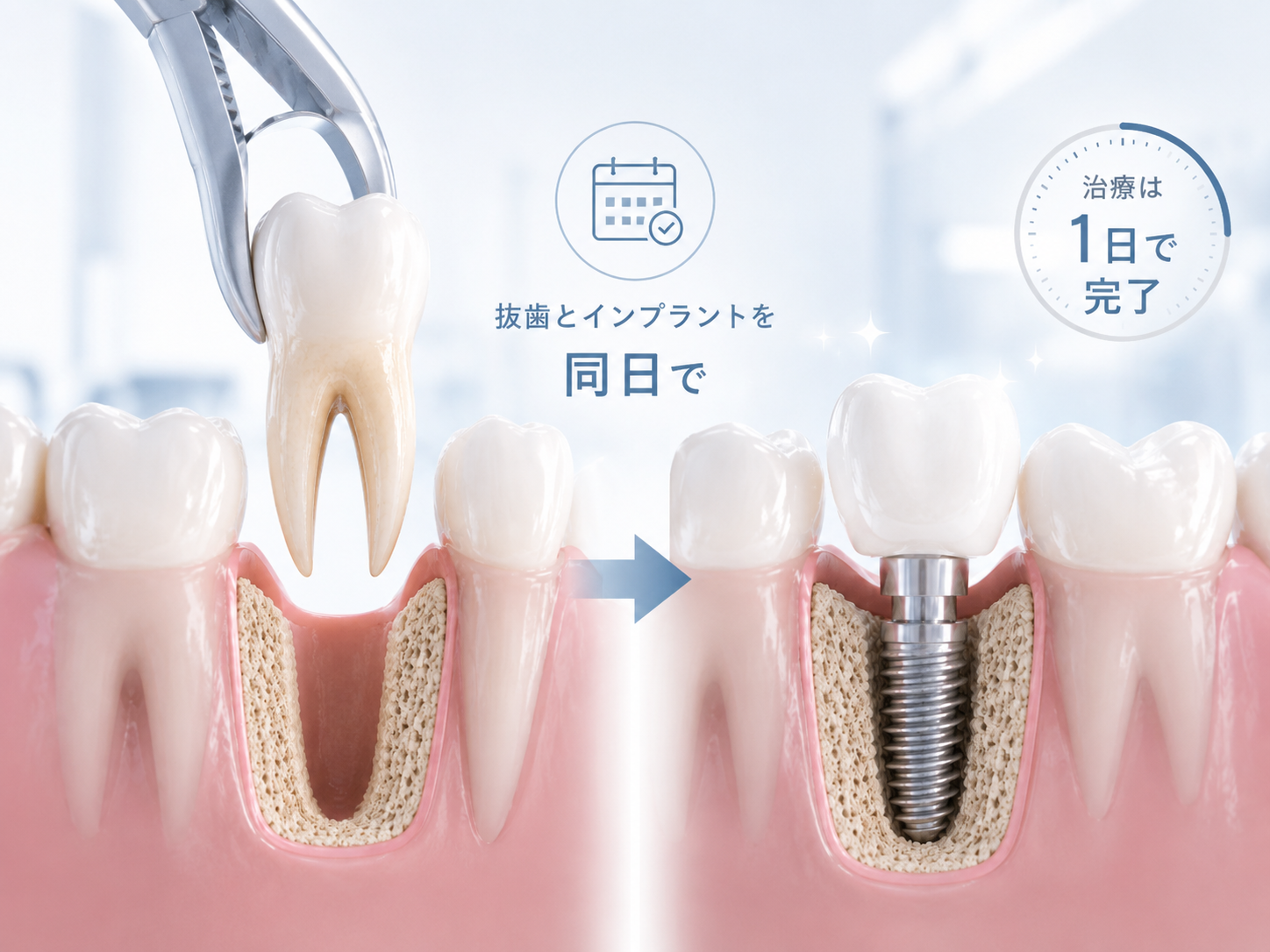 【府中】歯を抜いてすぐインプラントにできる？治療期間を短縮できる「抜歯即時インプラント」を解説